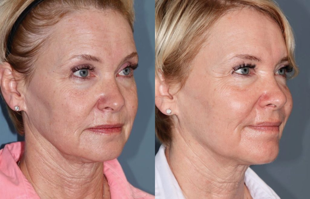 CO2 laser skin resurfacing at LeVogue Med Spa Temecula