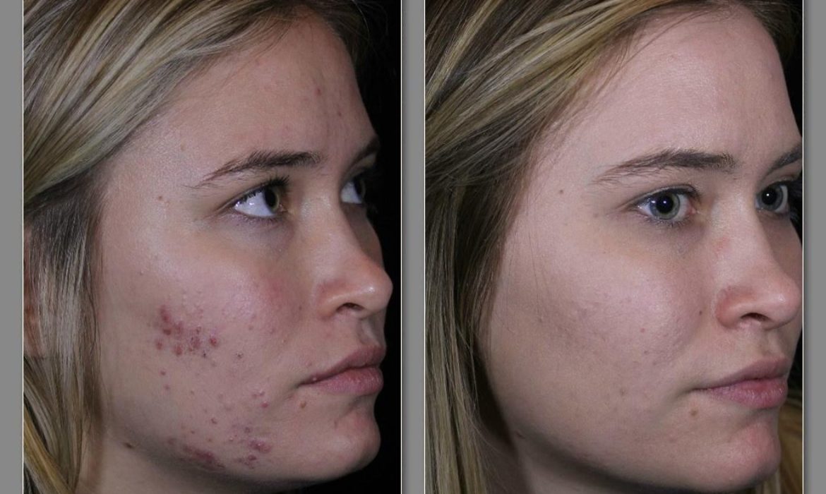 Acne facial treatment at LeVogue Med Spa Temecula