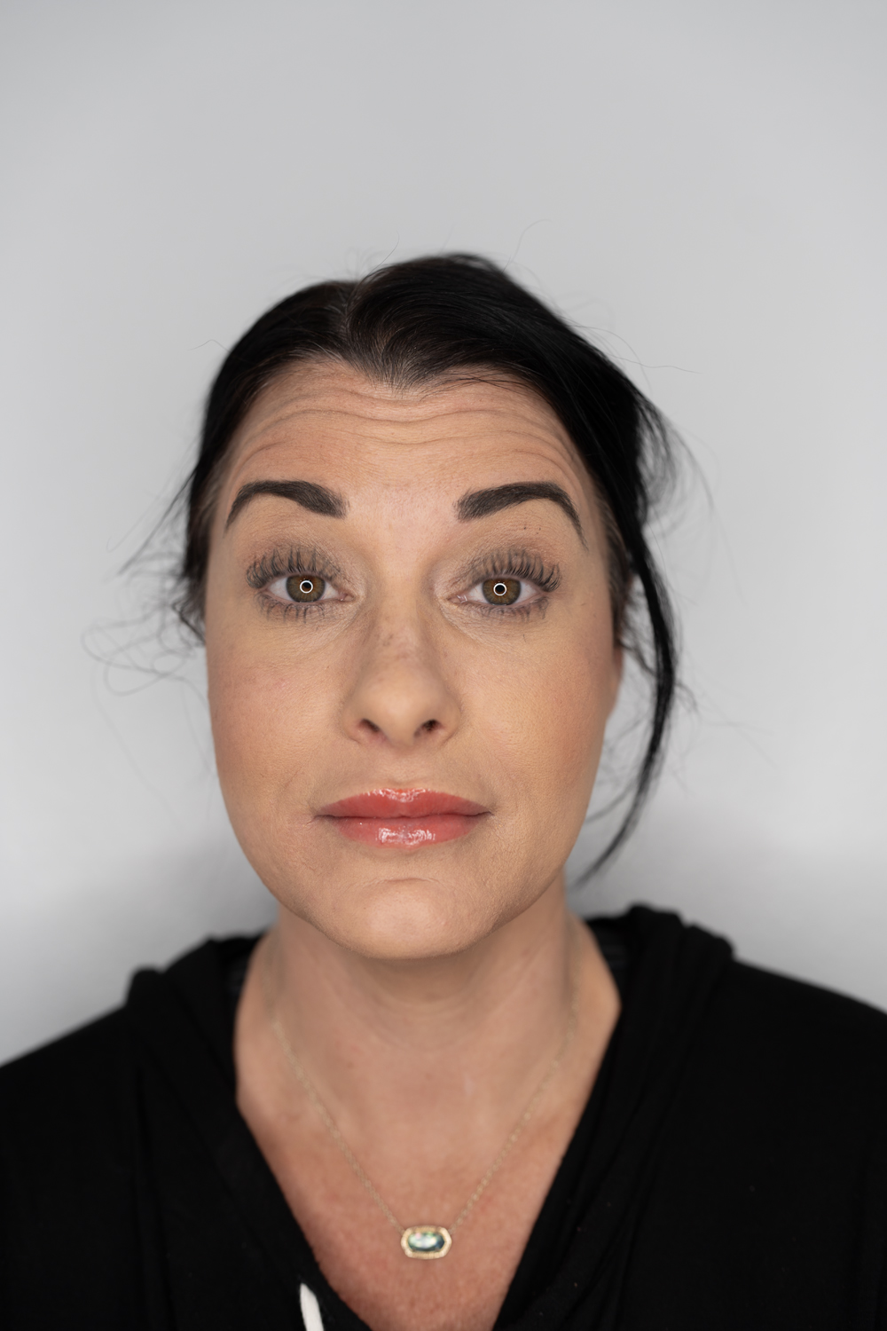 Ideal candidates for Botox at LeVogue Med Spa Cary