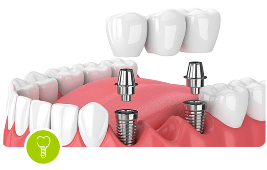 Refined Clear Aligner Experience