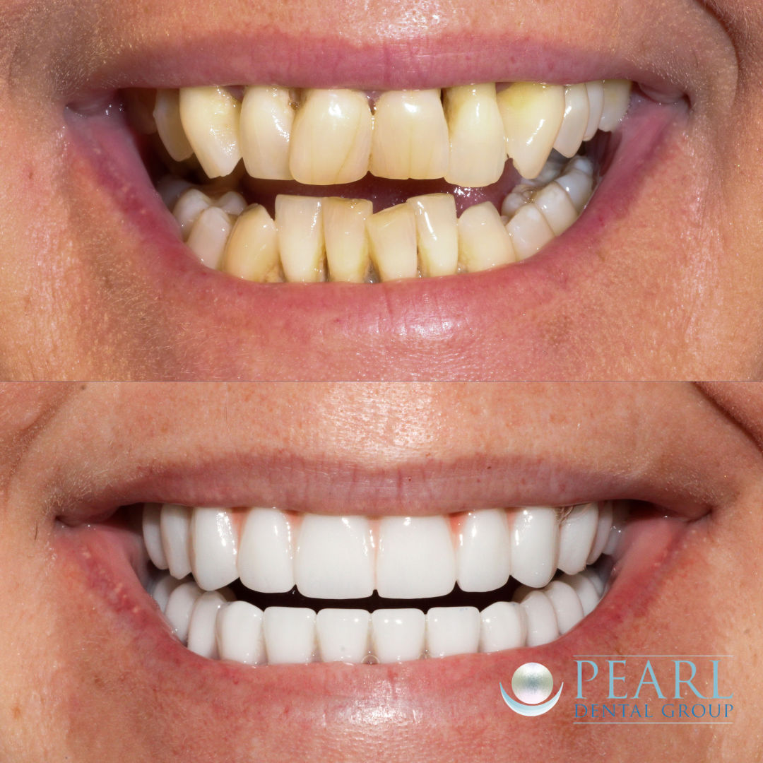 Smile makeover before and after - Pearl Dental Group