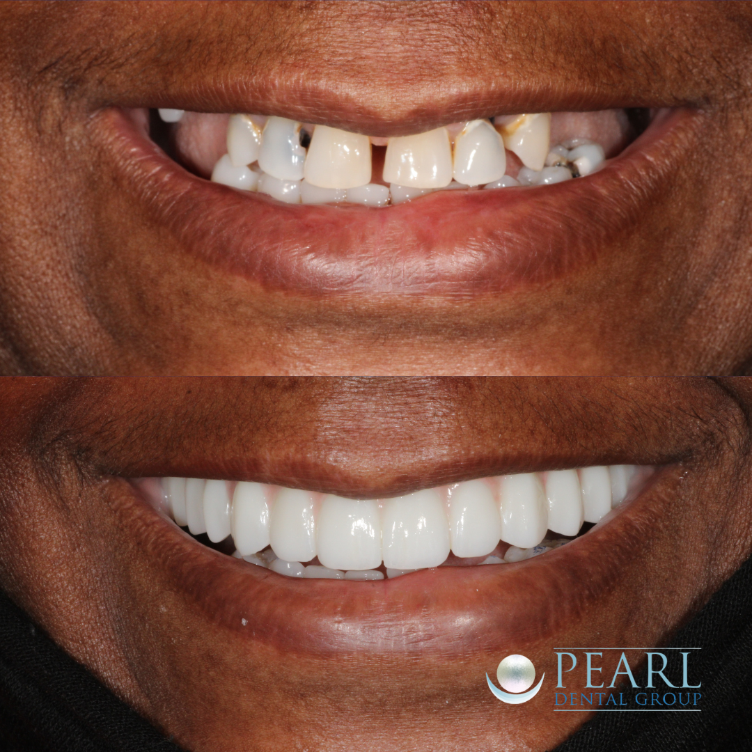 Dental implant before and after - Pearl Dental Group