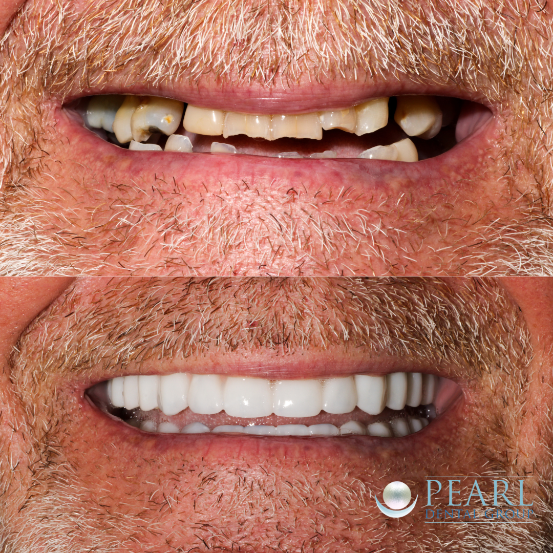 Full mouth dental implants before and after - Pearl Dental Group