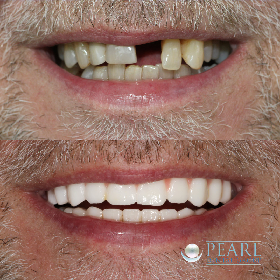 Dental implants before and after - Pearl Dental Group