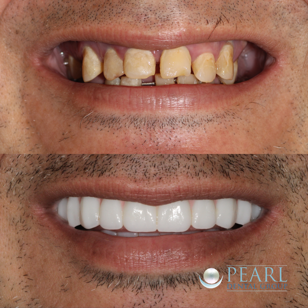 Implant smile transformation before and after - Pearl Dental Group