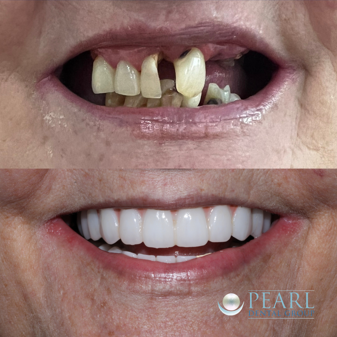 Full arch implants before and after - Pearl Dental Group