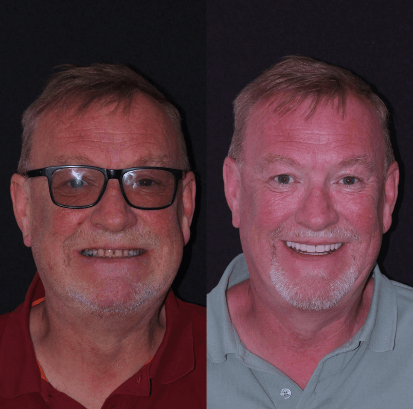 Emax veneer result - Primo Dental