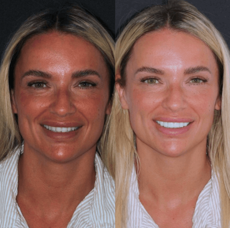 Emax veneer result - Primo Dental