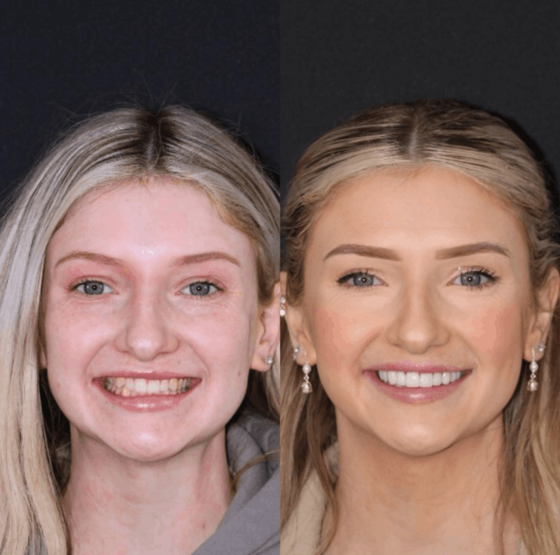 Emax veneer result - Primo Dental