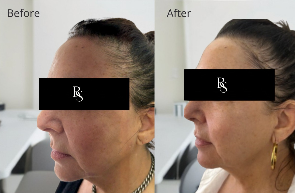 Refreshed mature woman with subtle non surgical face lift result Johannesburg