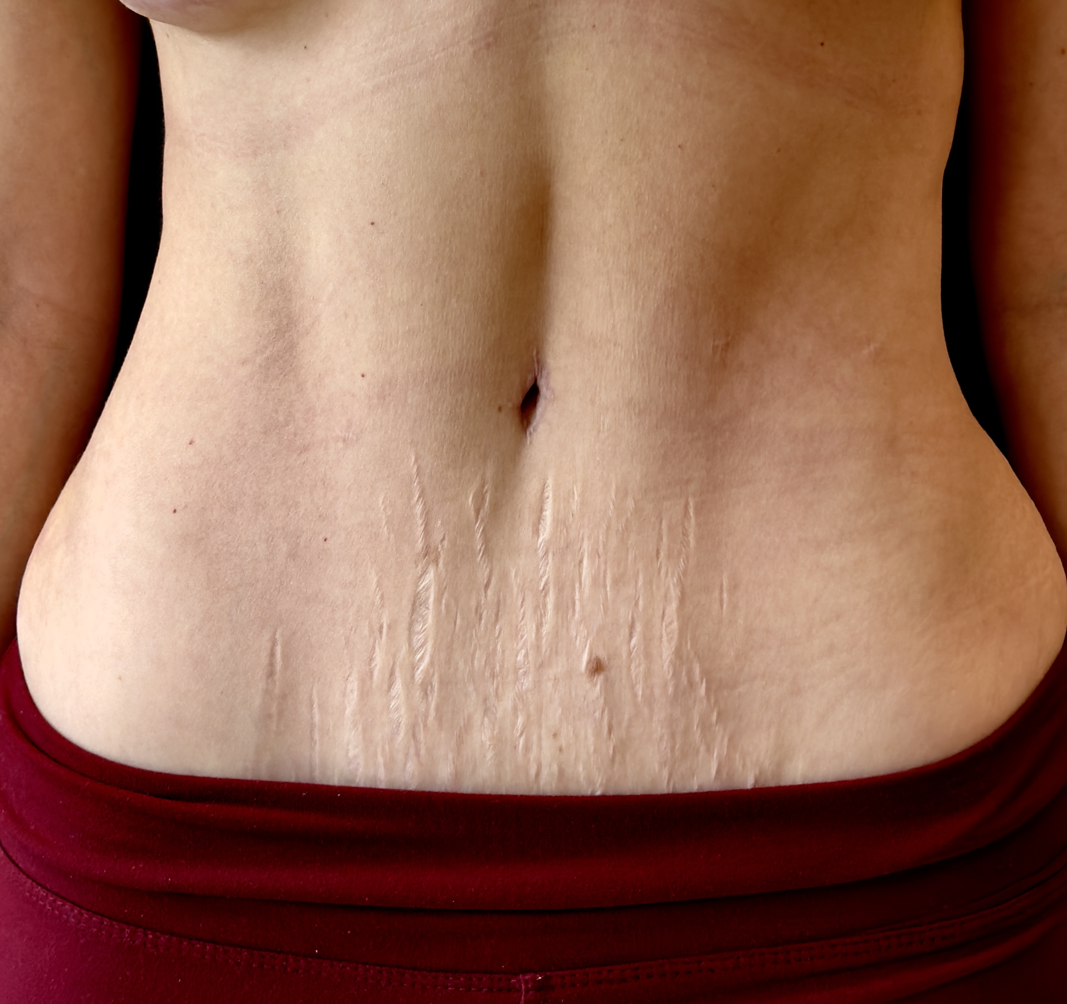 Abdominoplastía en CDMX