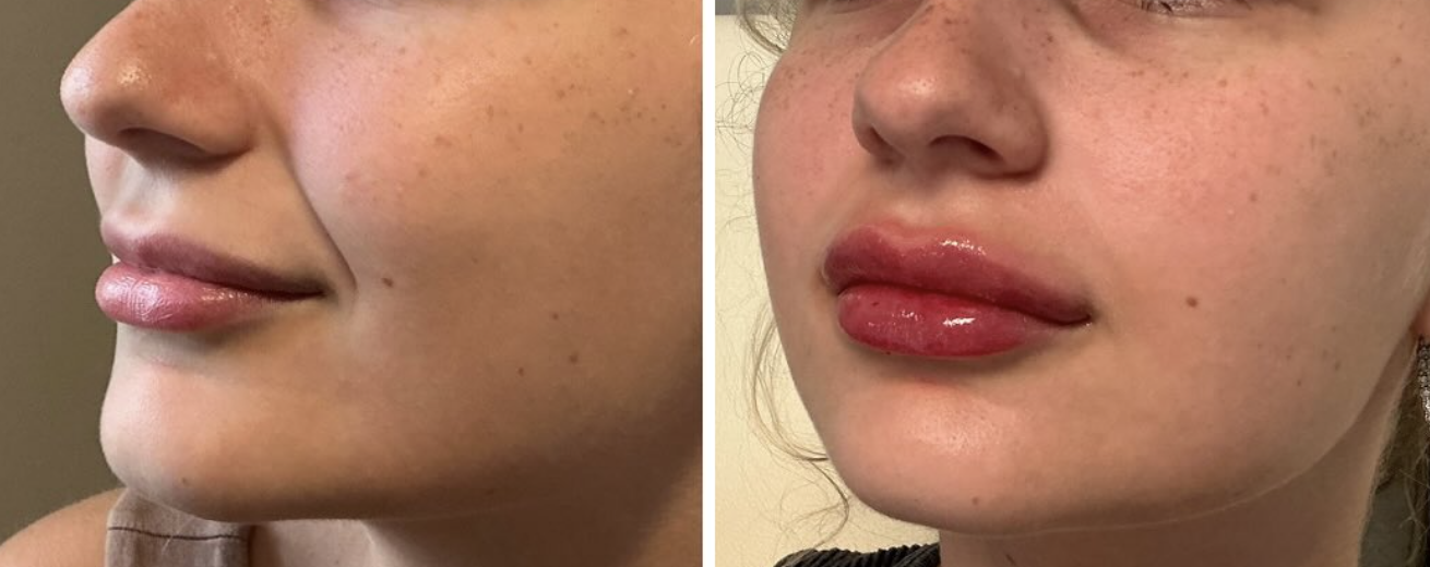 Lip filler Baton Rouge natural results RHA filler Coco Beauty Bar & Medical Spa