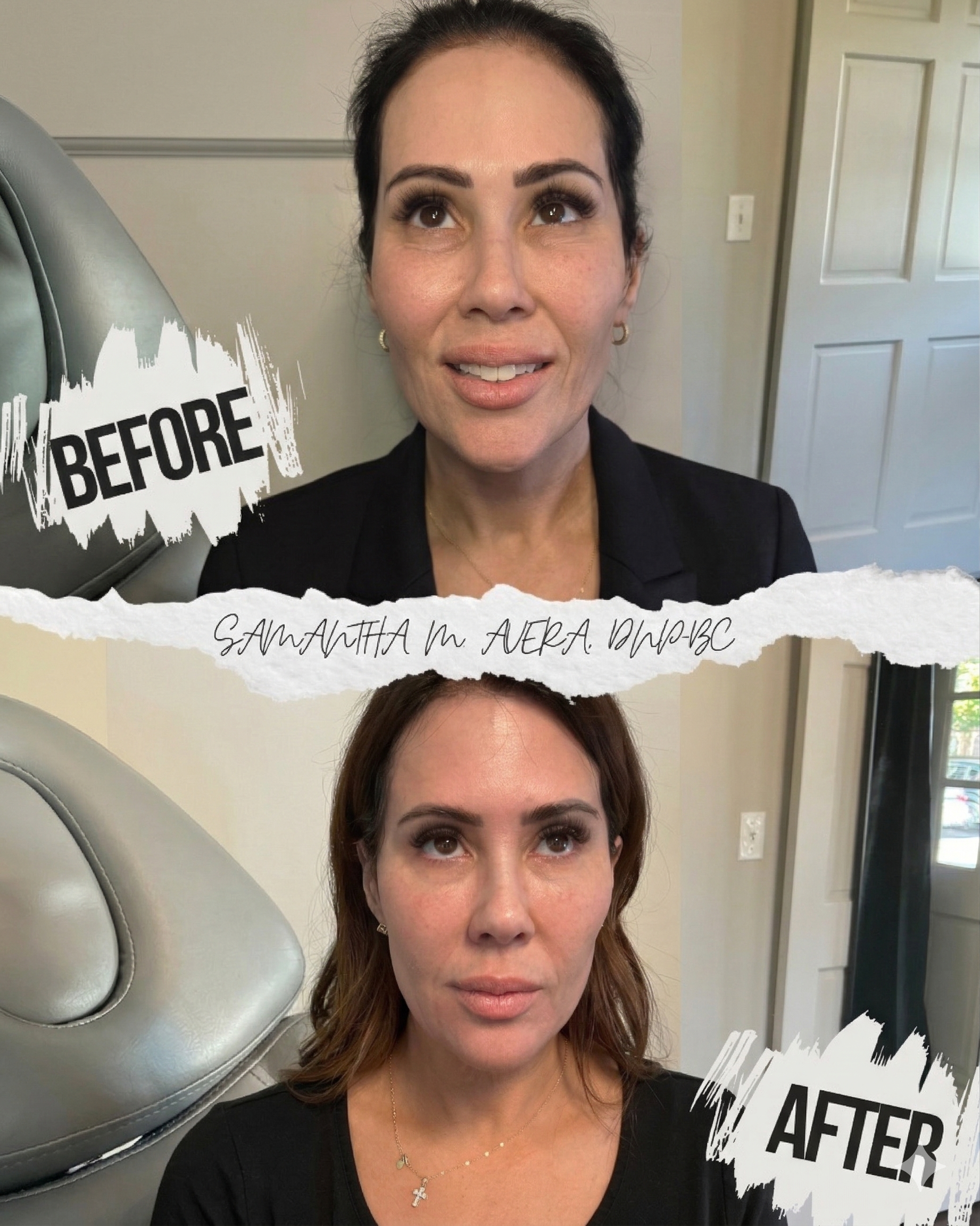 PRP bio filler Baton Rouge Cellenis Derma PRP natural skin rejuvenation Coco Beauty Bar & Medical Spa