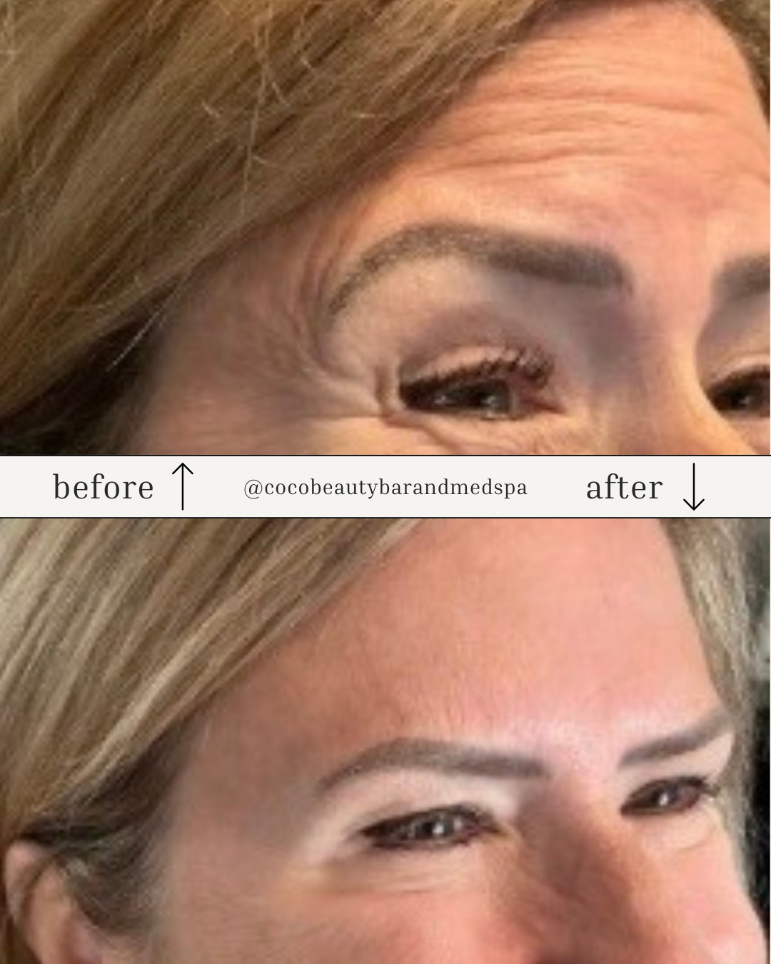 Botox treatment Baton Rouge natural results Coco Beauty Bar & Medical Spa Botox treatment Baton Rouge natural results Coco Beauty Bar & Medical Spa