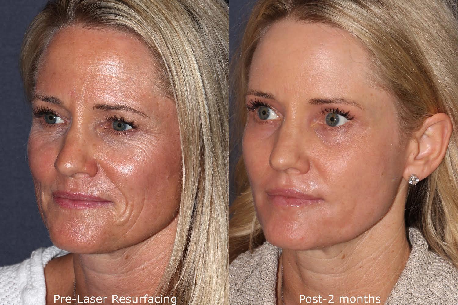 Nouvaderm laser treatment Baton Rouge skin resurfacing Coco Beauty Bar & Medical Spa Nouvaderm laser treatment Baton Rouge skin resurfacing Coco Beauty Bar & Medical Spa