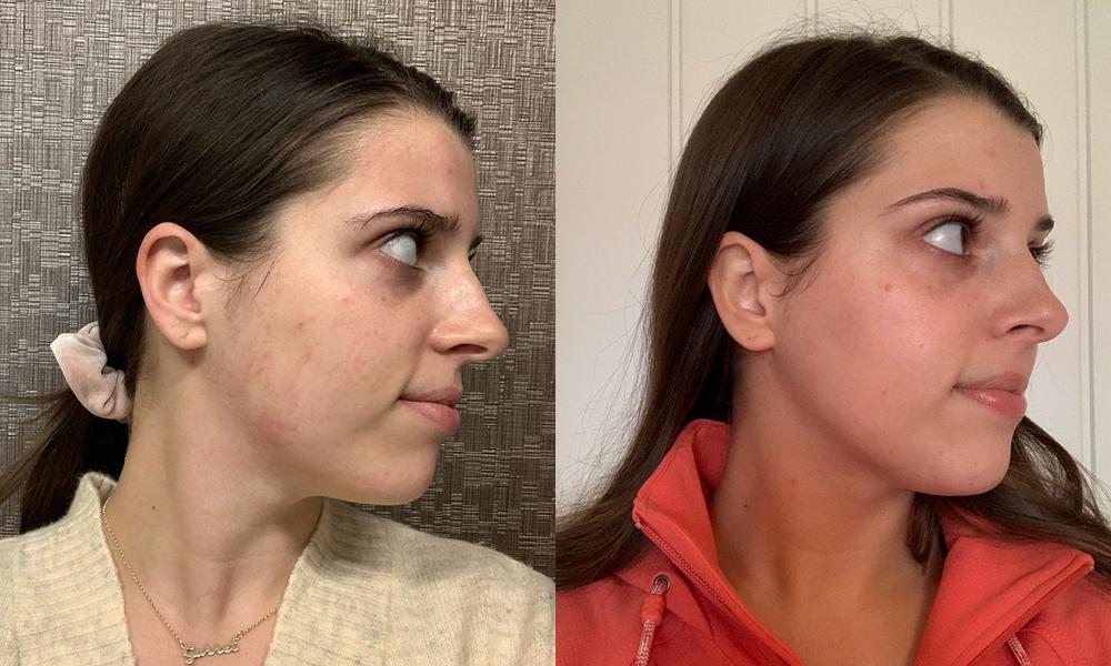 Nouvaderm laser treatment Baton Rouge skin resurfacing Coco Beauty Bar & Medical Spa Nouvaderm laser treatment Baton Rouge skin resurfacing Coco Beauty Bar & Medical Spa