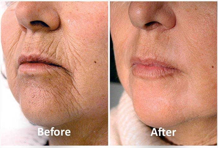Nouvaderm laser treatment Baton Rouge skin resurfacing Coco Beauty Bar & Medical Spa Nouvaderm laser treatment Baton Rouge skin resurfacing Coco Beauty Bar & Medical Spa
