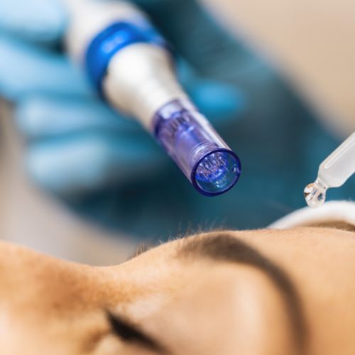A microneedling tool used for PRP Microneedling treatments at Image Clinic in Windsor