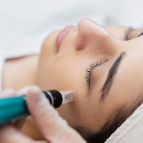 A microneedling tool used for PRP Microneedling treatments at Image Clinic in Windsor