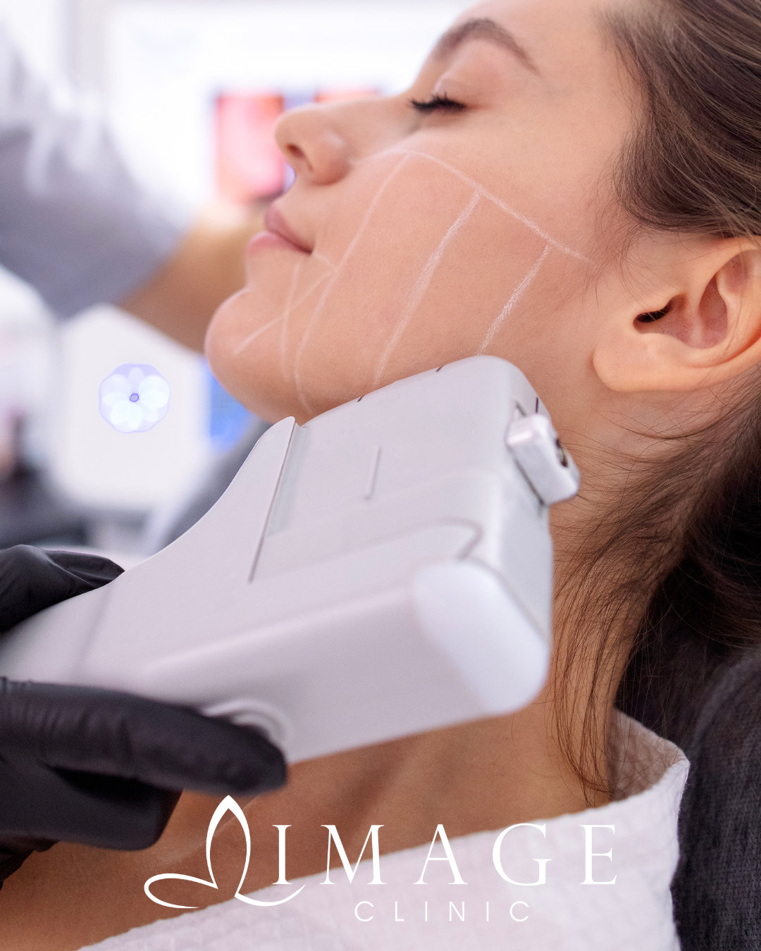 A client showing skin laxity before EndyMed Skin Tightening treatment in Windsor