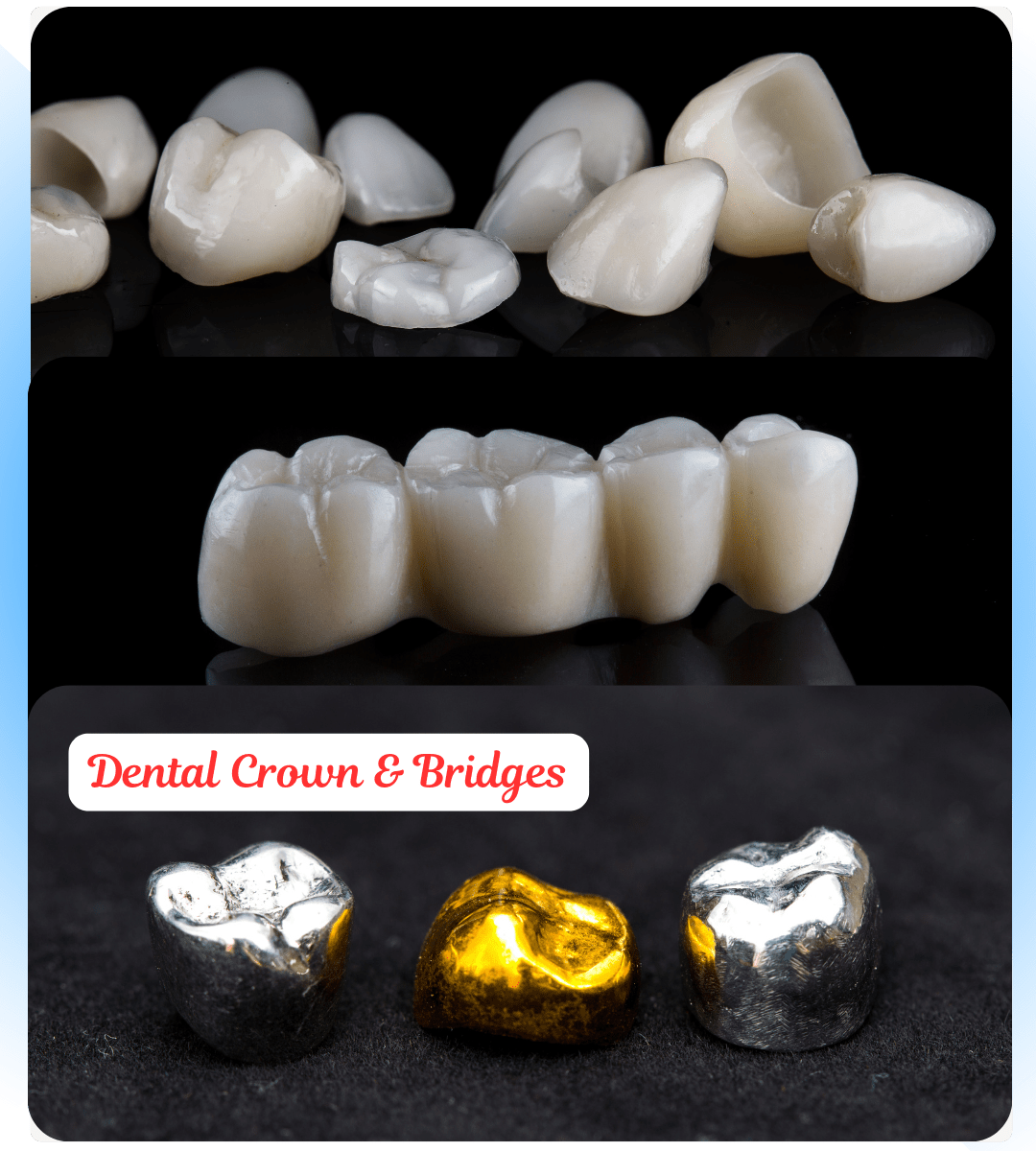 dental crowns