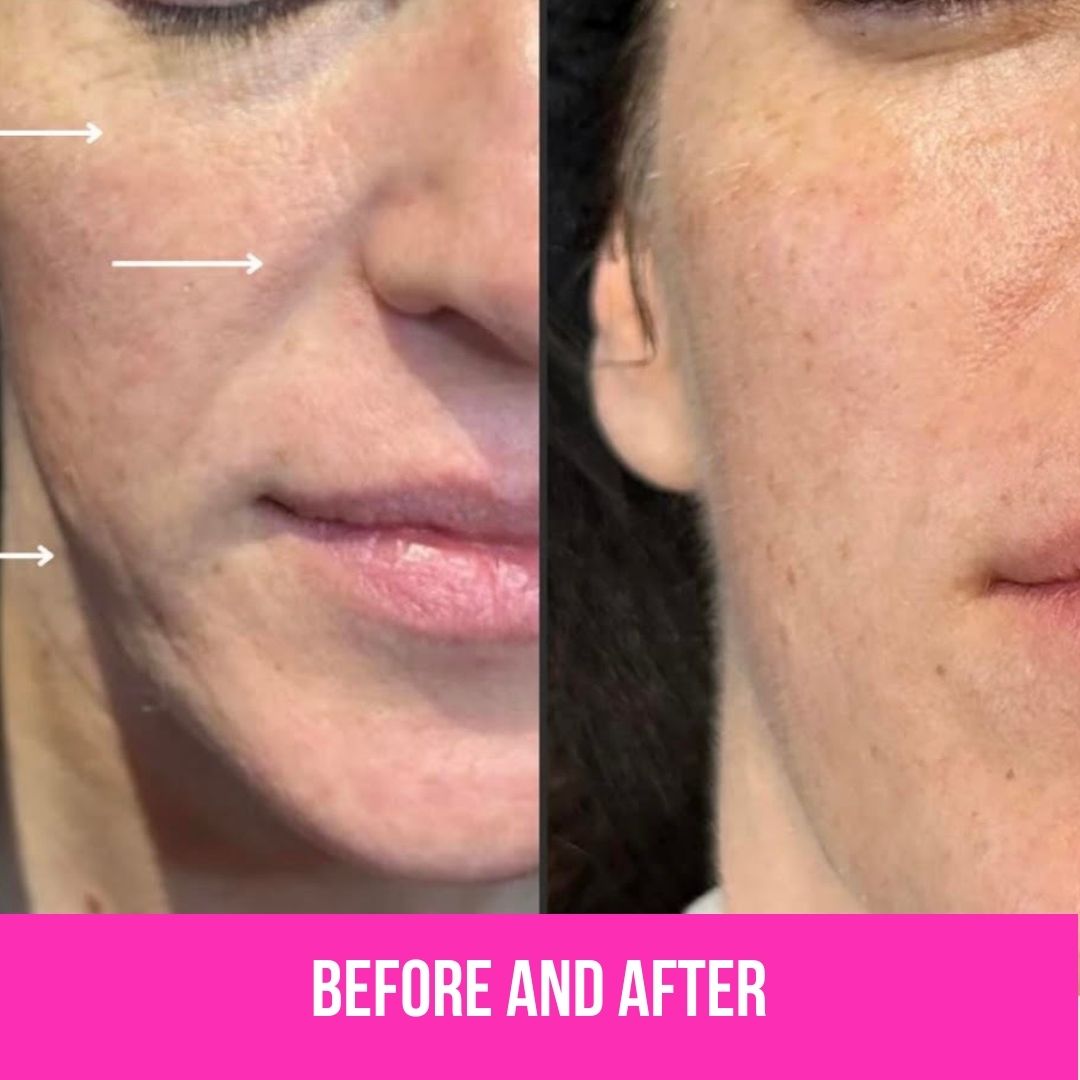 Before and after Tixel treatment showing natural skin improvement