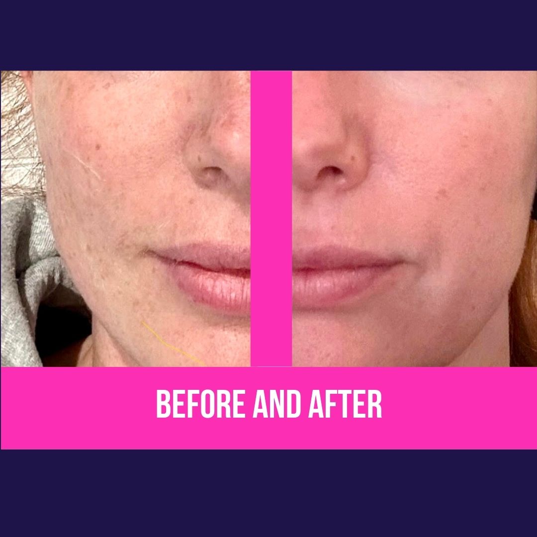 Gentle skin rejuvenation with Tixel
