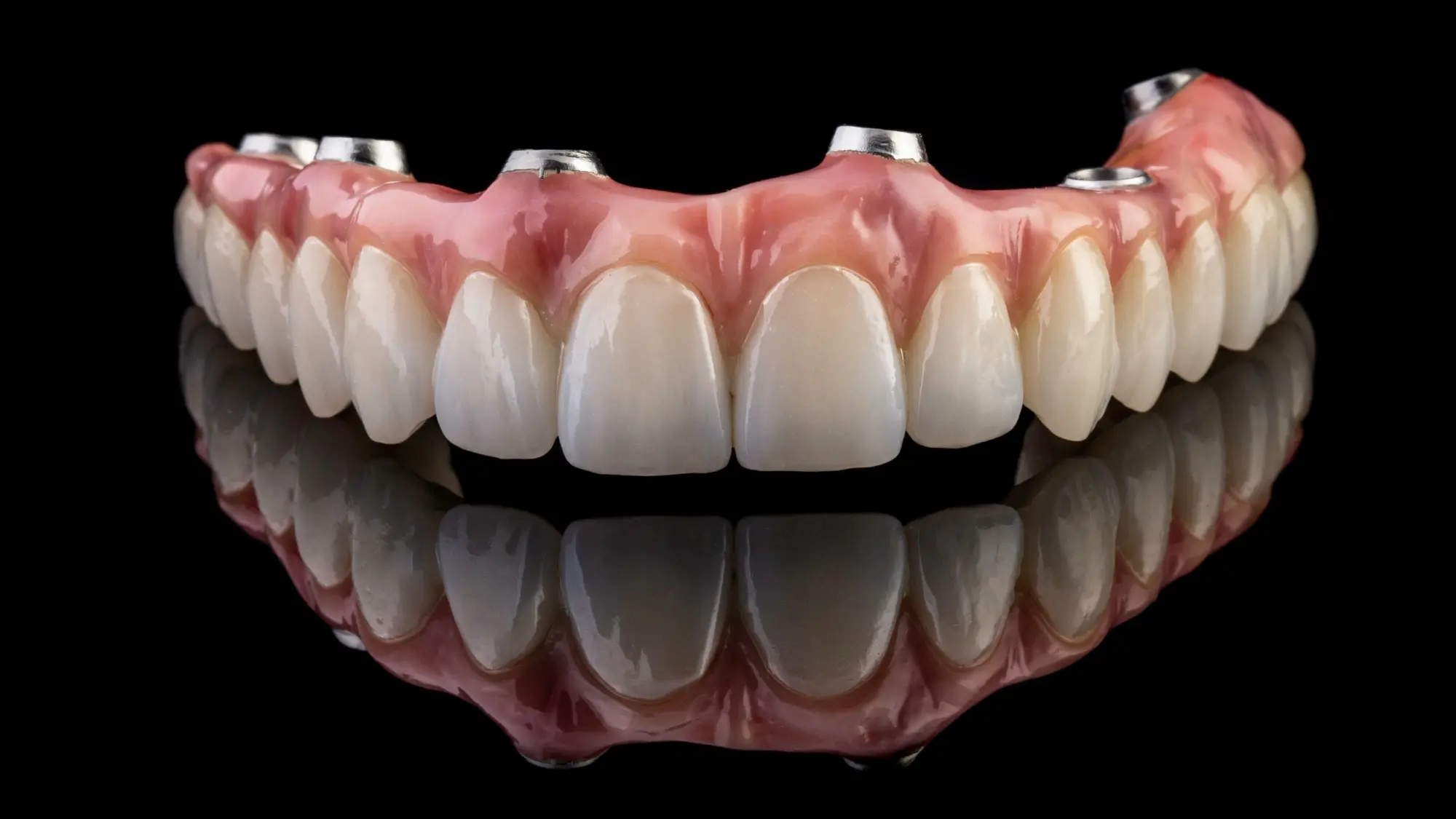 Implantes de arco completo