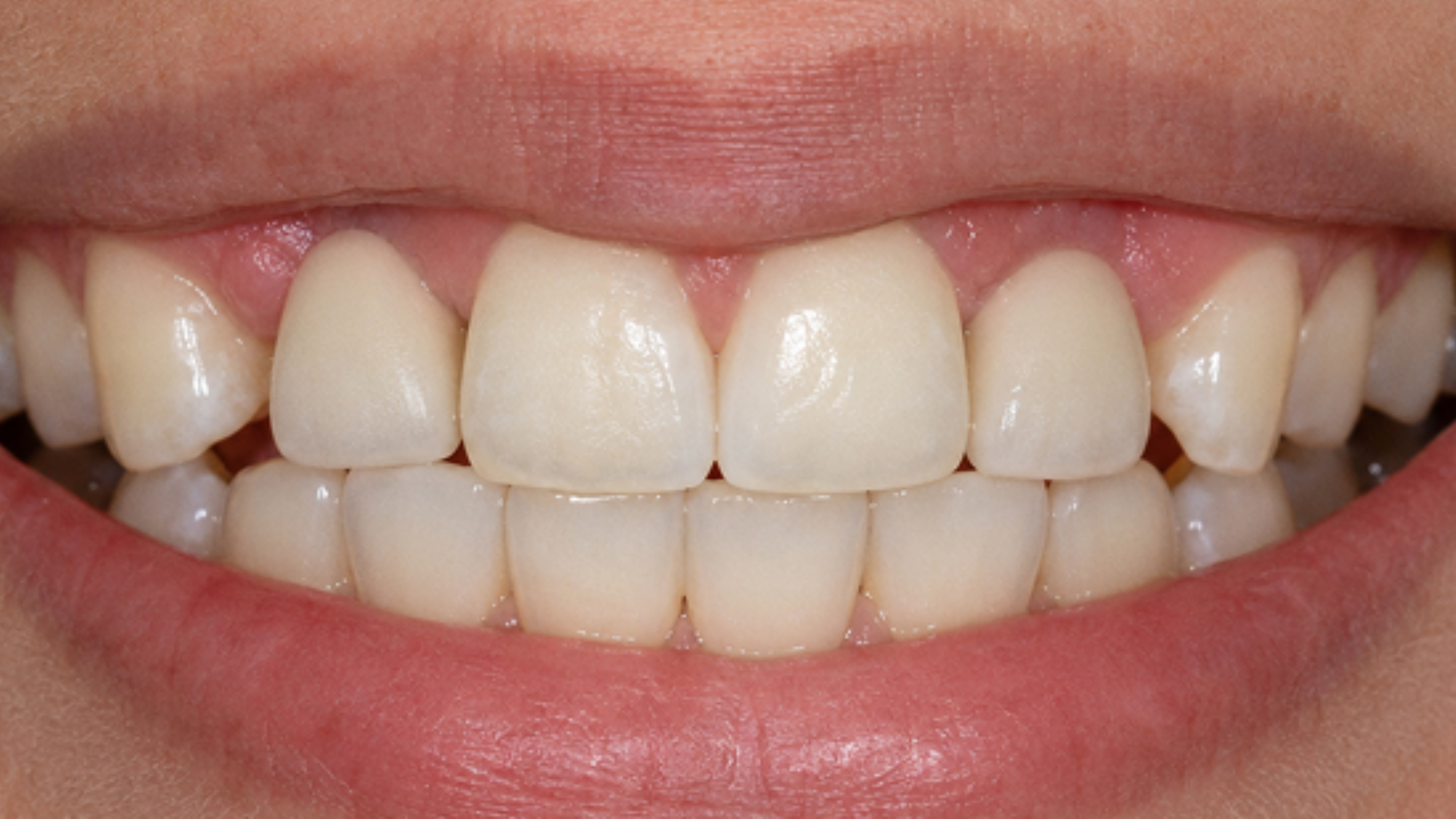 After dental treatment