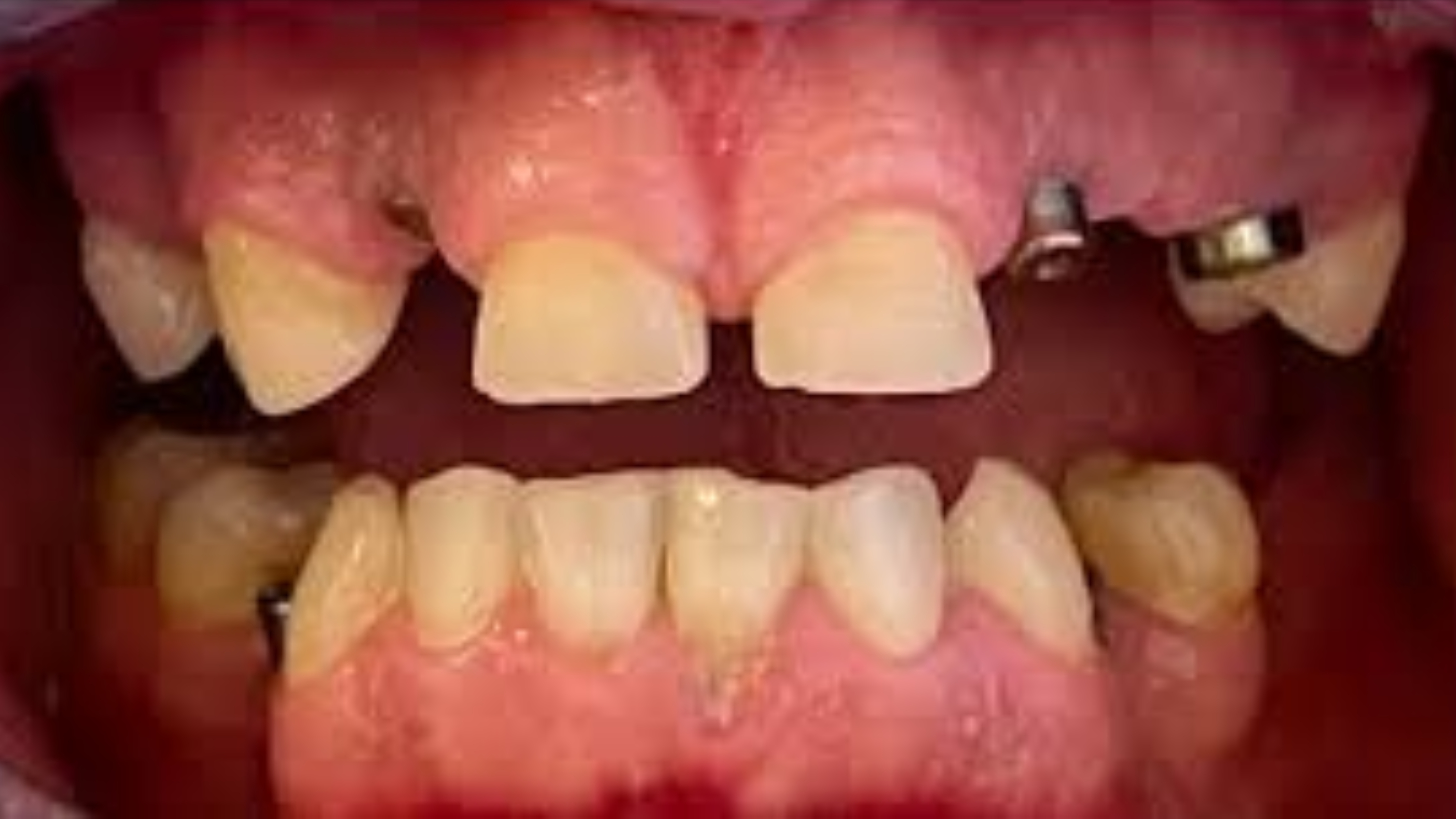 Before dental treatment