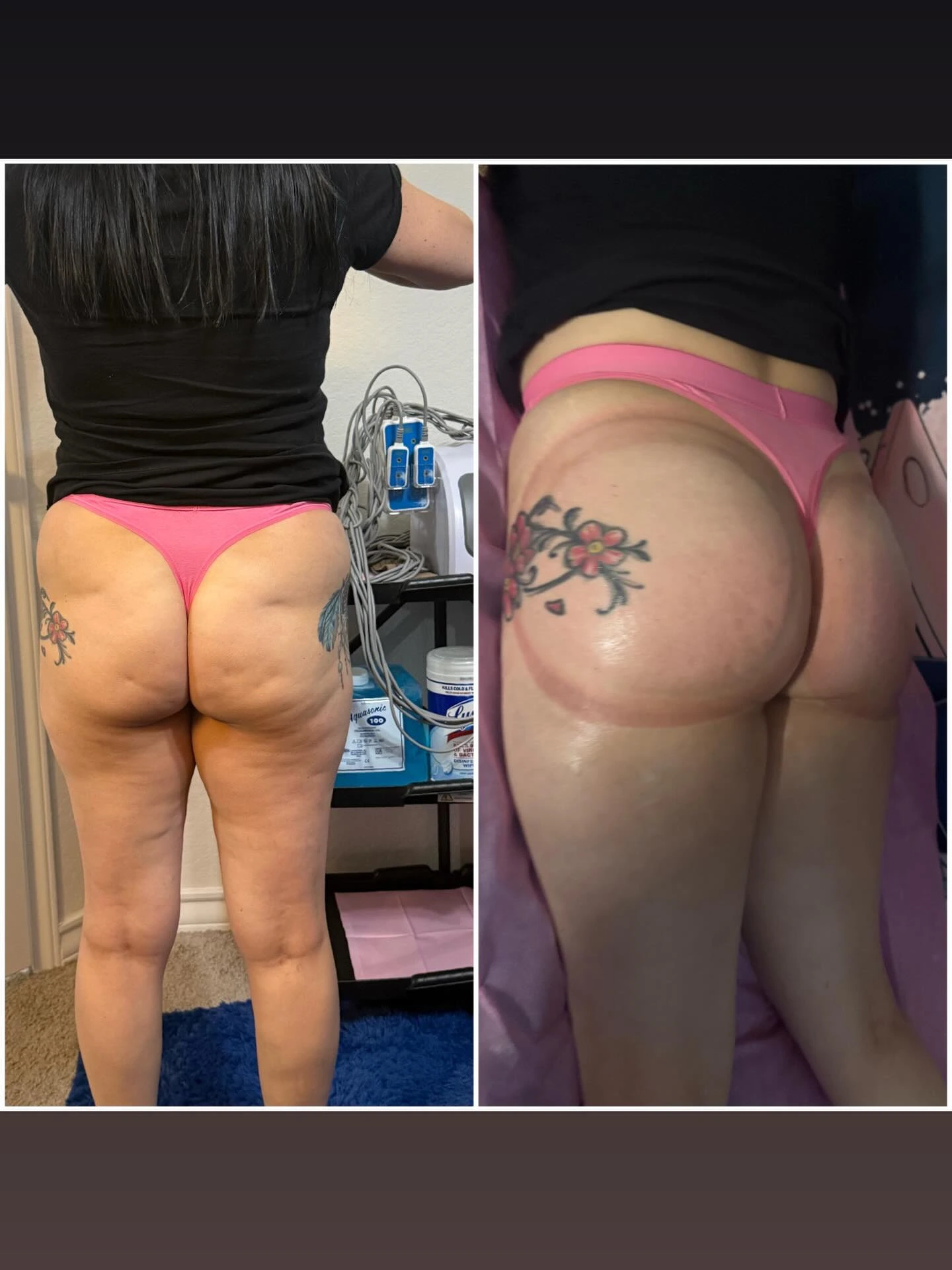 Sculpting treatment session