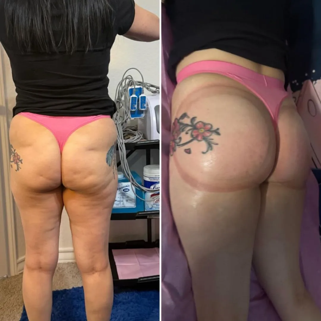 Smoother, more lifted buttocks before and after a non-invasive booty lift in San Antonio