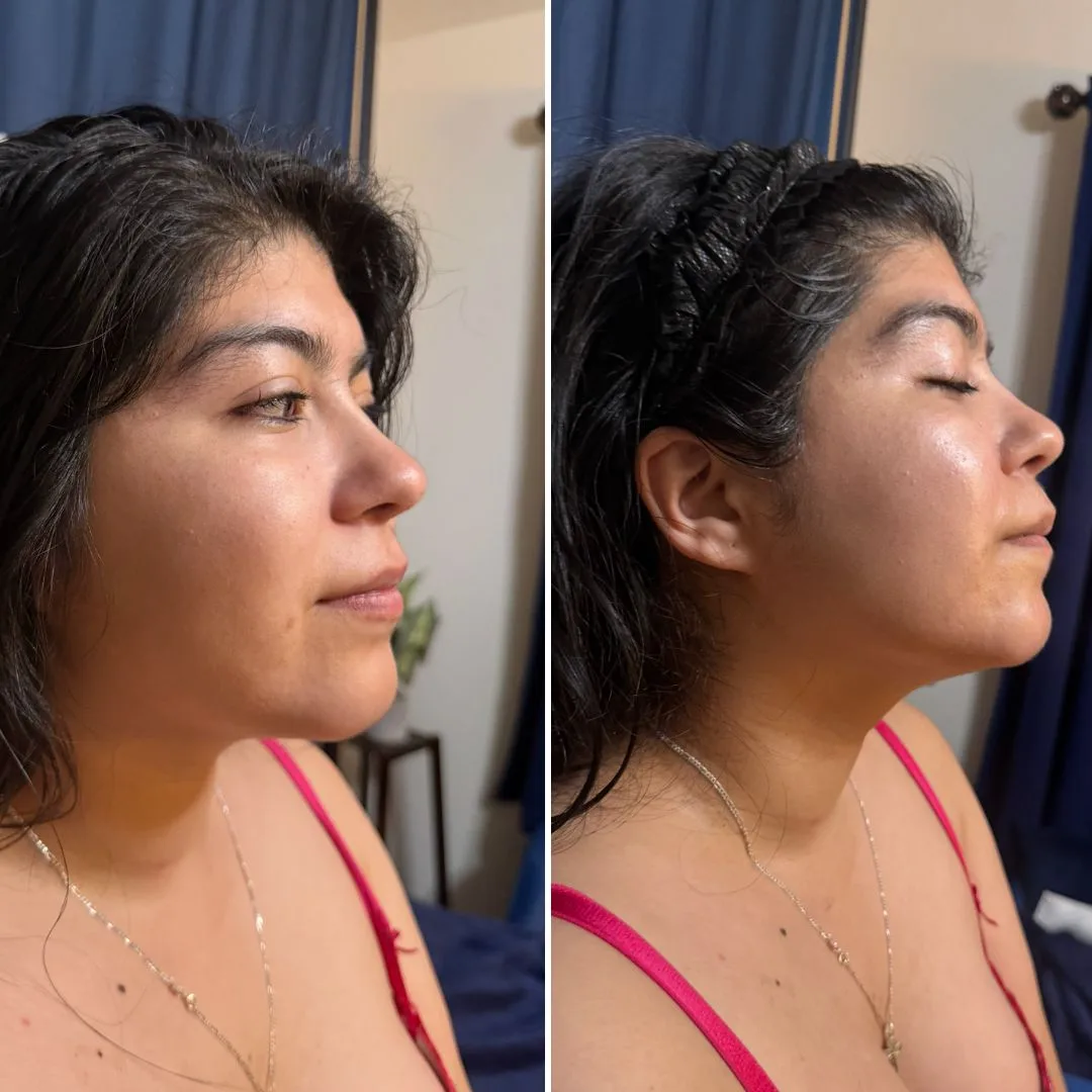 Refined chin and jawline before and after non-invasive sculpting in San Antonio