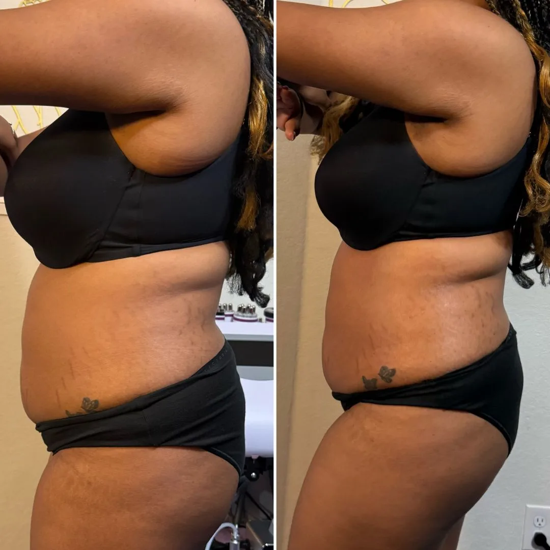Contoured abdomen and waist, before and after non-invasive body sculpting in San Antonio