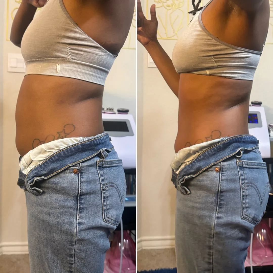 More defined waistline before and after non-invasive body sculpting in San Antonio