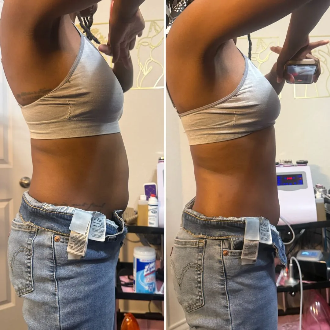 Flatter, tighter waistline before and after non-invasive body sculpting in San Antonio