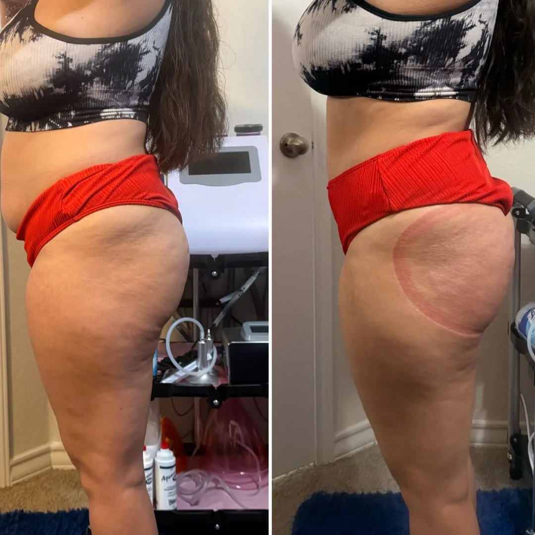 Snatched waist and lifted curves before and after non-invasive sculpting in San Antonio