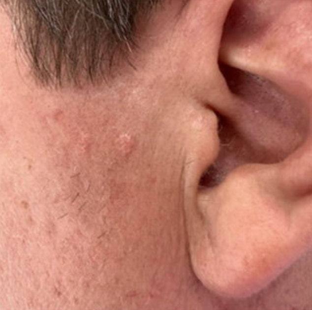 Face the Facts The Truth About Sebaceous Hyperplasia My Skin