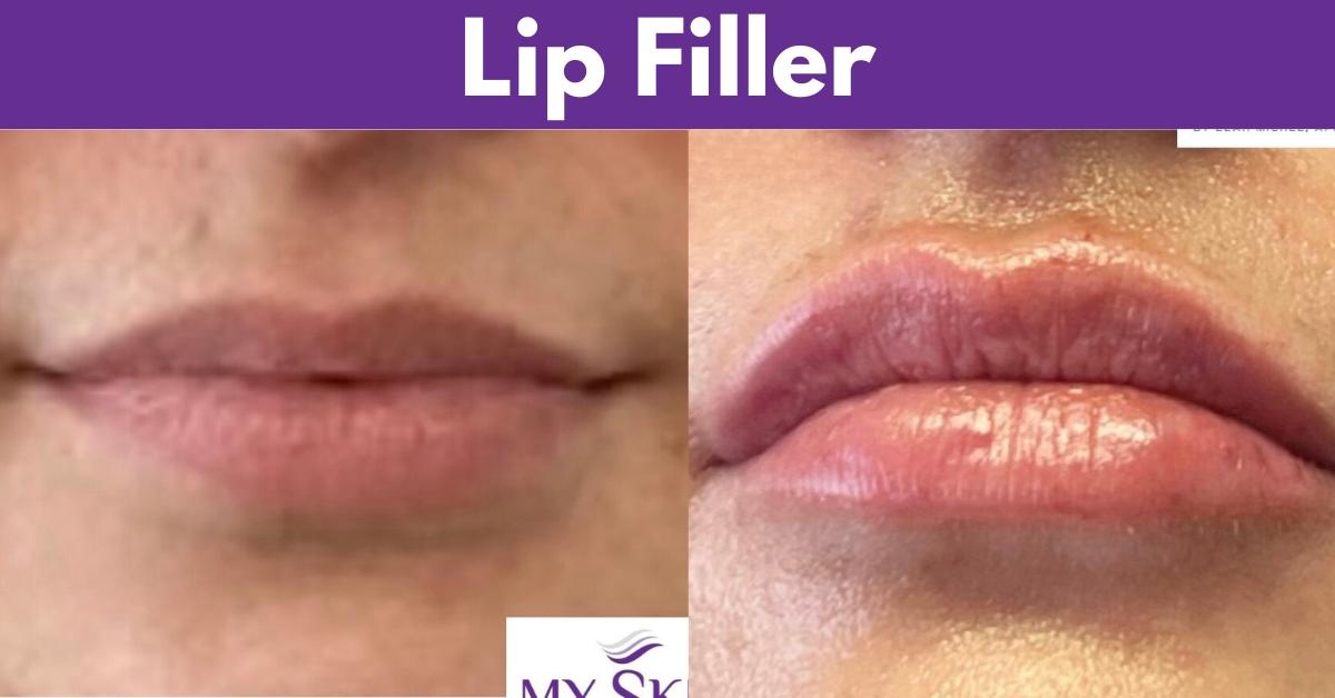 Lip Filler services at My Skin St Pete and My Skin Bradenton
