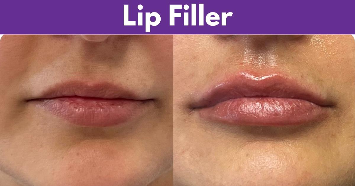 Lip filler services at My Skin St Pete and My Skin Bradenton