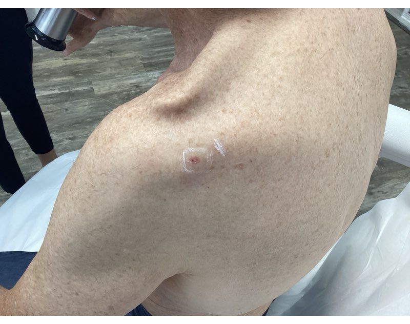 skin cancer that looks like a pimple skin cancer that looks like a pimple