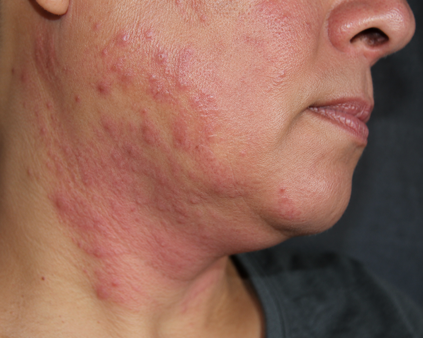 Skin Sarcoidosis My Skin St Pete My Skin Bradenton
