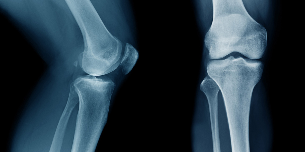 Knee X-ray showing side and front views of the knee joint Knee X-ray showing side and front views of the knee joint