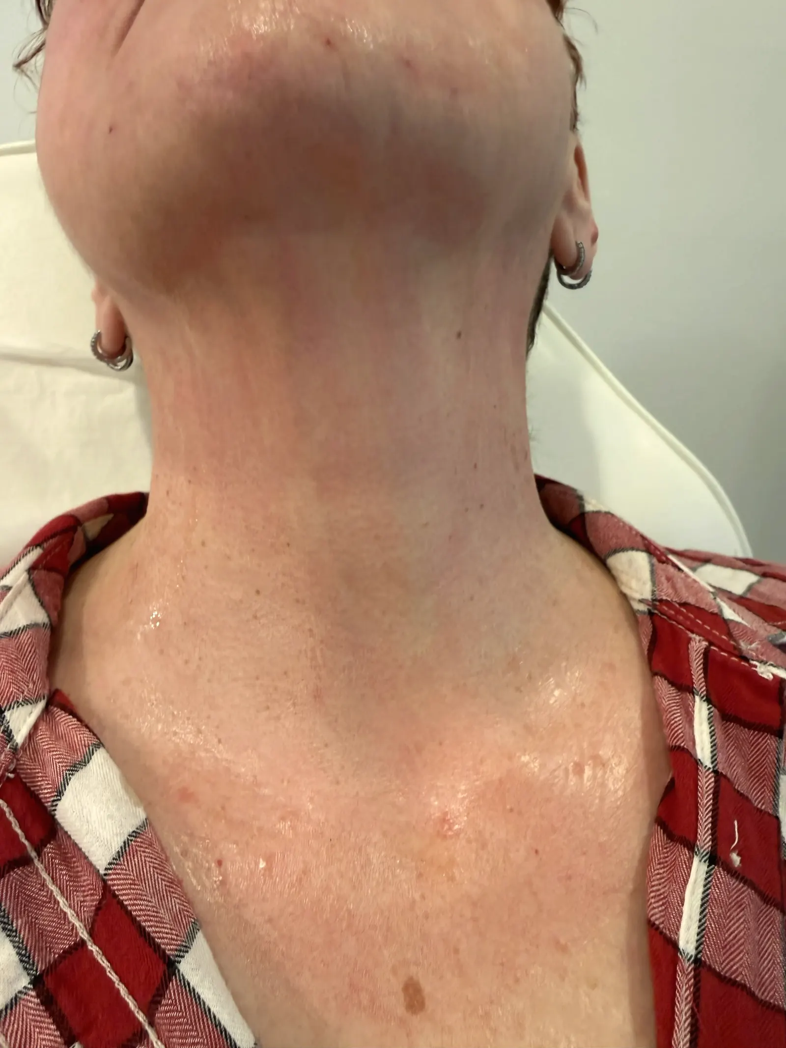 Microneedling with PRP for skin renewal and collagen stimulation