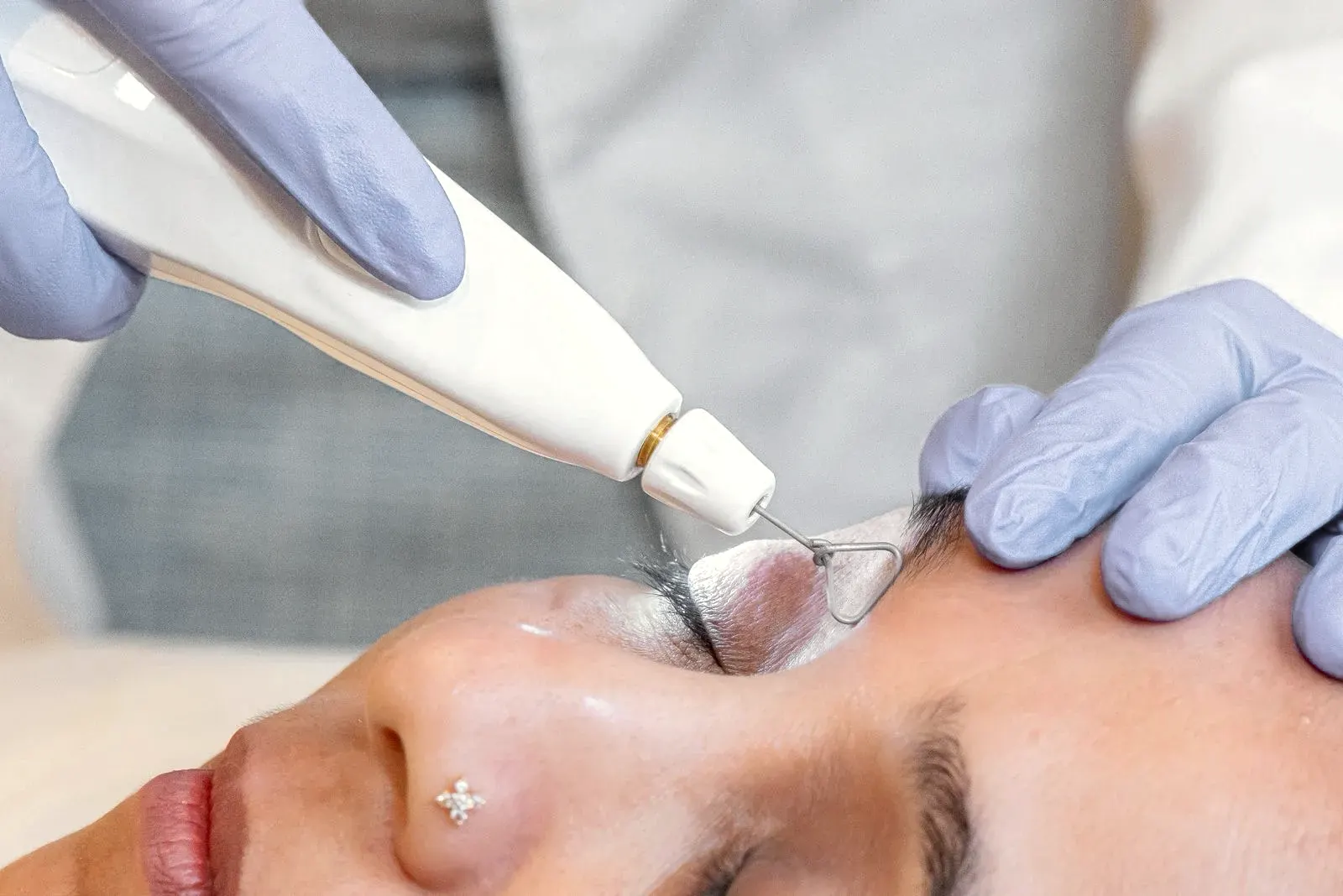 Non-surgical eyelid lift with plasma at Arbour Longevity