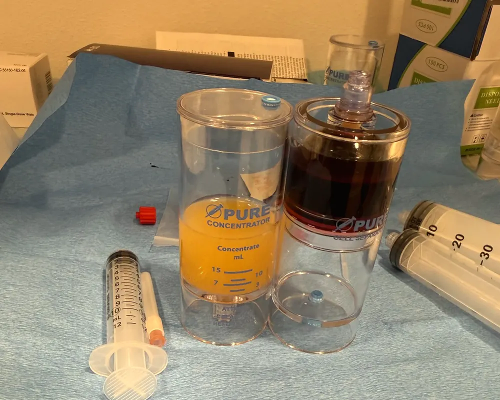 PRP facial rejuvenation treatment for skin renewal at Arbour Longevity