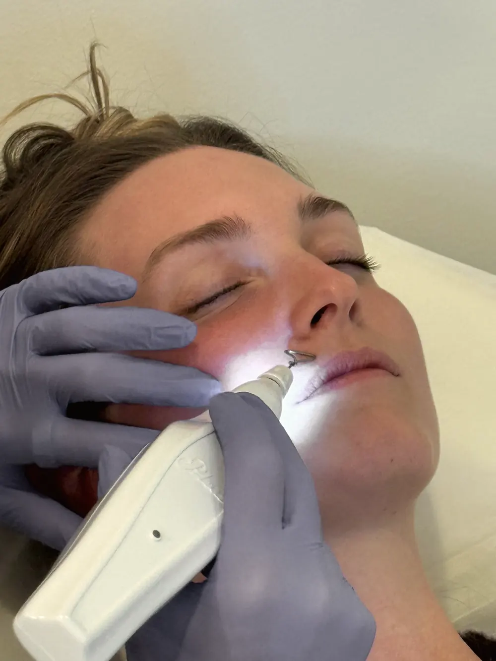 Plexr Plus plasma device treating the skin at Arbour Longevity