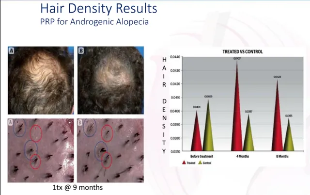 Published hair-density data for PRP in androgenic alopecia, treated versus control at four and eight months