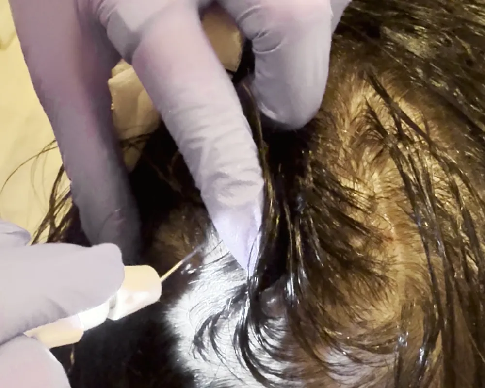 Scalp treatment for hair restoration at Arbour Longevity