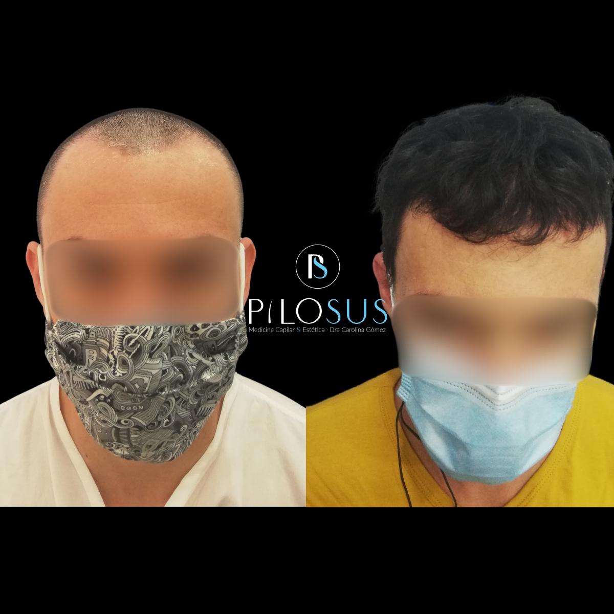 Caso real de restauración capilar, Pilosus